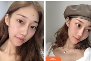 貴陽(yáng)愛爾眼科醫(yī)院胡大立整形價(jià)格表附眼部綜合案例展示