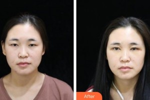 貴陽愛爾眼科醫(yī)院劉忠華整形價格表附眼部綜合案例展示