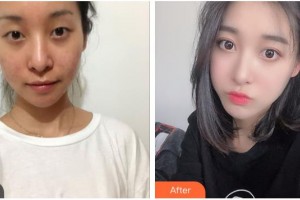 貴陽(yáng)愛爾眼科醫(yī)院廖進(jìn)軍整形價(jià)格表附切開雙眼皮案例展示