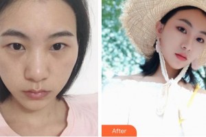 貴陽(yáng)愛爾眼科醫(yī)院鐘燕整形價(jià)格表附眼部綜合案例展示