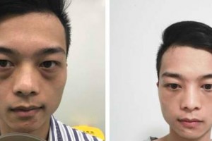 貴陽(yáng)愛爾眼科醫(yī)院黃加兵整形價(jià)格表附激光去眼袋案例展示