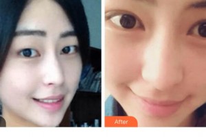 貴陽(yáng)愛爾眼科醫(yī)院陳曉玲整形價(jià)格表附切開雙眼皮案例展示