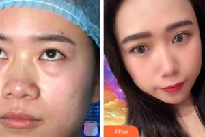 貴陽(yáng)愛爾眼科醫(yī)院王文放整形價(jià)格表附內(nèi)切祛眼袋案例展示