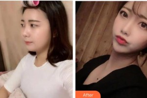 貴陽(yáng)愛爾眼科醫(yī)院楊潔整形價(jià)格表附切開雙眼皮案例展示