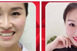 遵義利美康整形美容醫(yī)院史躍興整形價(jià)格表附隱形托槽矯正案例展示