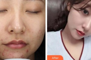 遵義利美康整形美容醫(yī)院王波整形價(jià)格表附激光祛斑案例展示