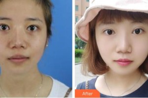 遵義利美康整形美容醫(yī)院龍文萍整形價(jià)格表附激光祛斑案例展示