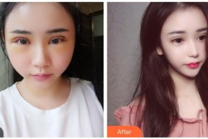遵義韓美整形美容醫(yī)院汪玉云整形價(jià)格表附切開雙眼皮案例展示