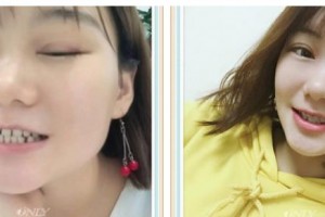 遵義利美康整形美容醫(yī)院劉福榮整形價格表附牙齒隱形矯正案例展示