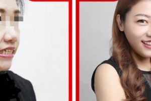 遵義醫(yī)學(xué)院附院美容醫(yī)院?jiǎn)J連勝整形價(jià)格表附牙齒隱形矯正案例展示