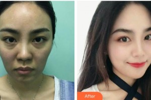 遵義醫(yī)學(xué)院附院美容醫(yī)院孫娜娜整形價格表附埋線提升案例展示