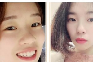 遵義韓美整形美容醫(yī)院李志強(qiáng)整形價格表附牙齒陶瓷矯正案例展示