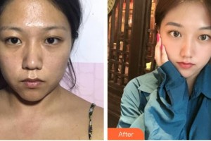 遵義韓美整形美容醫(yī)院羅艷紅整形價格表附激光祛斑案例展示