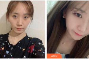 遵義韓美整形美容醫(yī)院安基云整形價格表附顴骨顴弓整形術(shù)案例展示