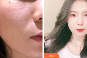 遵義現(xiàn)代皮膚病醫(yī)院劉雅楠整形價格表附彩光嫩膚案例展示