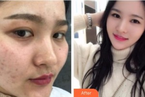 遵義喬雅菲醫(yī)療美容門診部羅碧強(qiáng)整形價(jià)格表附紅藍(lán)光祛痘案例展示