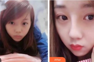 遵義喬雅菲醫(yī)療美容門診部彭于賓整形價格表附清潔祛痘案例展示