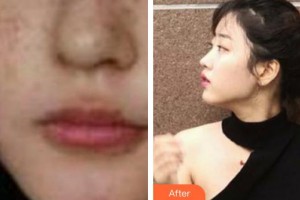 遵義韓美整形美容醫(yī)院李正鵬整形價格表附激光祛斑案例展示