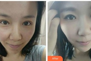 遵義現(xiàn)代皮膚病醫(yī)院陳炳全整形價格表附紅藍(lán)光祛痘案例展示