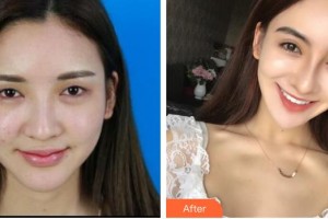 銅仁韓美時(shí)光醫(yī)療美容門診部張雪梅整形價(jià)格表附切開雙眼皮案例展示