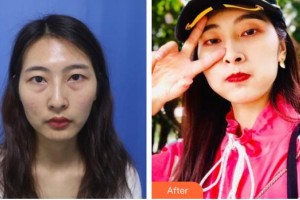 銅仁韓美時(shí)光醫(yī)療美容門診部劉真宏整形價(jià)格表附激光去眼袋案例展示