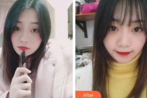 黔西南興義京州口腔醫(yī)院張雁整形價(jià)格表附牙齒隱形矯正案例展示