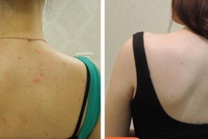 畢節(jié)利美康醫(yī)療美容門診部劉冰語整形價(jià)格表附清潔祛痘案例展示