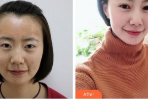 畢節(jié)陽明眼科醫(yī)院梁占瑩整形價(jià)格表附切開雙眼皮案例展示