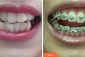 青海康華整形醫(yī)院時(shí)林月整形價(jià)格表附金屬托槽矯正案例展示