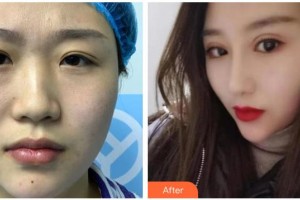 青海康華整形醫(yī)院馮相周整形價(jià)格表附耳軟骨復(fù)合隆鼻案例展示