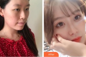 青海紅十字醫(yī)院整形美容科李桂梅整形價(jià)格表附自體軟骨墊鼻尖案例展示