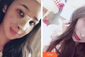 青?？等A整形醫(yī)院馬晶整形價(jià)格表附鼻部綜合案例展示