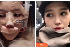 青?？等A整形醫(yī)院蔡志昆整形價(jià)格表附鼻部綜合案例展示