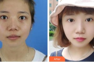 青?？等A整形醫(yī)院宋羽整形價(jià)格表附激光祛斑案例展示