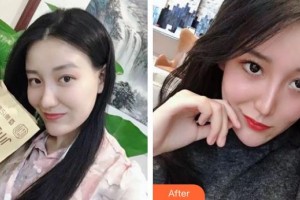 張家港康麗?？漆t(yī)院整形美容外科開學蘭住院醫(yī)師整形價格表附清潔祛痘案例展示