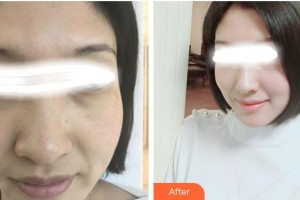 張家港康麗?？漆t(yī)院整形美容外科陸玉萍整形價格表附美白嫩膚案例展示