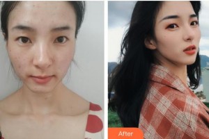 張家港萬春醫(yī)院整形美容中心趙學燕整形價格表附清潔祛痘案例展示