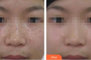 張家港唯恩醫(yī)療美容醫(yī)院鄭偉整形價格表附激光祛斑案例展示