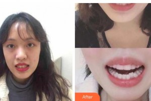 張家港康麗?？漆t(yī)院整形美容外科范立國整形價格表附牙齒隱形矯正案例展示