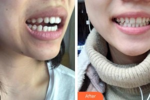 張家港萬春醫(yī)院整形美容中心朱萬春整形價格表附牙齒隱形矯正案例展示