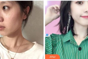 張家港容麗妍醫(yī)療美容門診部樸嘉真整形價格表附激光祛斑案例展示