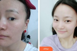 張家港容麗妍醫(yī)療美容門診部許紅麗整形價格表附去痘印痘坑案例展示