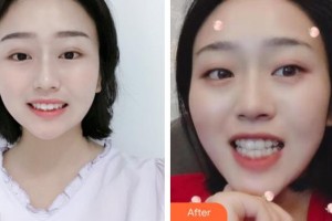 張家港康麗專科醫(yī)院整形美容外科劉勝整形價格表附牙齒隱形矯正案例展示