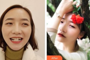 武警廣西總隊醫(yī)院醫(yī)學整形美容中心林瓏整形價格表附牙齒隱形矯正案例展示