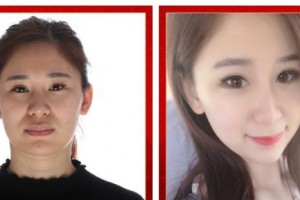 武警廣西總隊醫(yī)院醫(yī)學(xué)整形美容中心張潮整形價格表附埋線提升案例展示