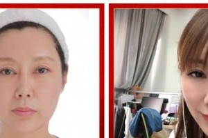 廣西醫(yī)科大學美容整形中心黎凍整形價格表附埋線提升案例展示