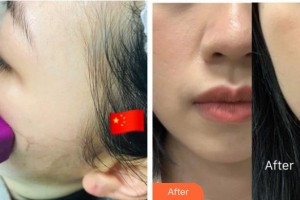 武警廣西總隊醫(yī)院醫(yī)學(xué)整形美容中心張樹芳 整形價格表附熱瑪吉案例展示