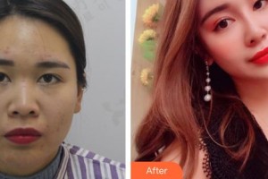 廣西醫(yī)科大學美容整形中心周翔整形價格表附耳軟骨復合隆鼻案例展示