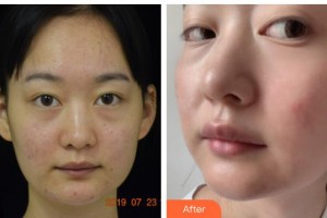 廣西醫(yī)科大學美容整形中心韋潔整形價格表附去痘印痘坑案例展示