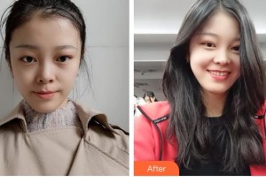 廣西愛思特整形外科醫(yī)院肖翔轅整形價格表附微針美膚案例展示